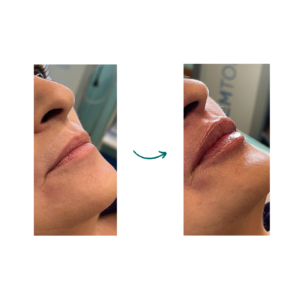 filler labbra calabria
