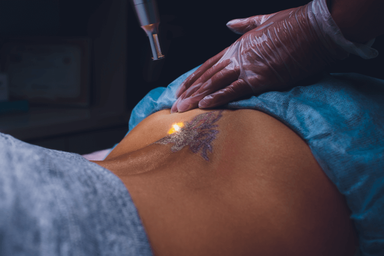 rimozione tatuaggi con laser a Lamezia