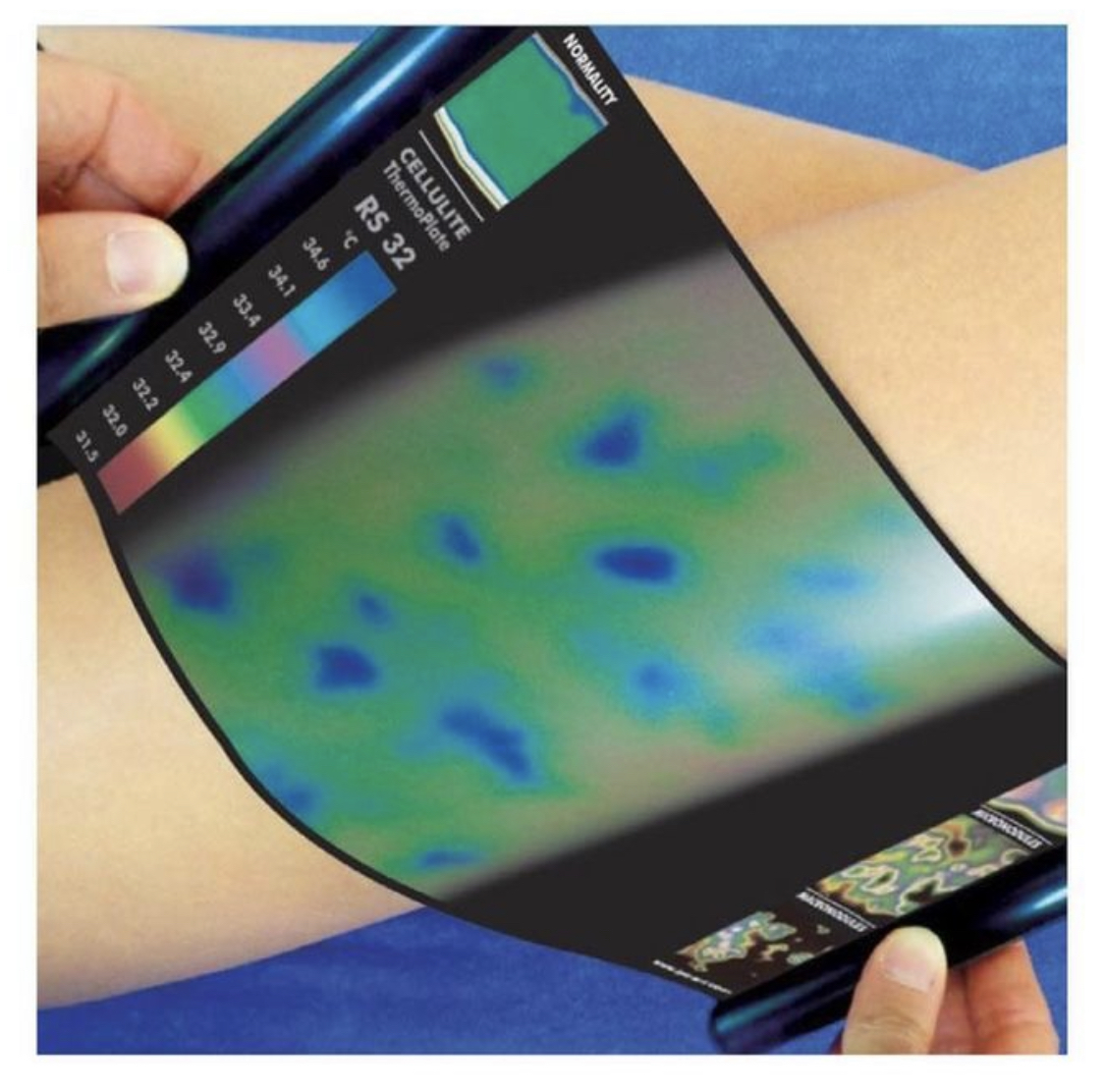 Check up con lastre termografiche cellulite